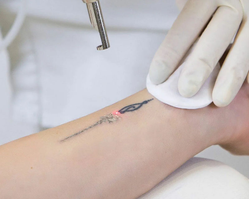 девушке удаляют татуировку с запястья